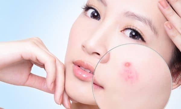 VÌ SAO MỤN TÁI PHÁT LIÊN TỤC DÙ ĐÃ CHĂM SÓC DA KỸ?